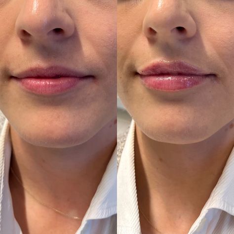  1 ml Lip Filler Manila: Enhance Your Natural Beauty