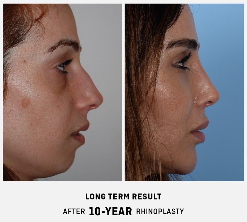  10 Years After Rhinoplasty