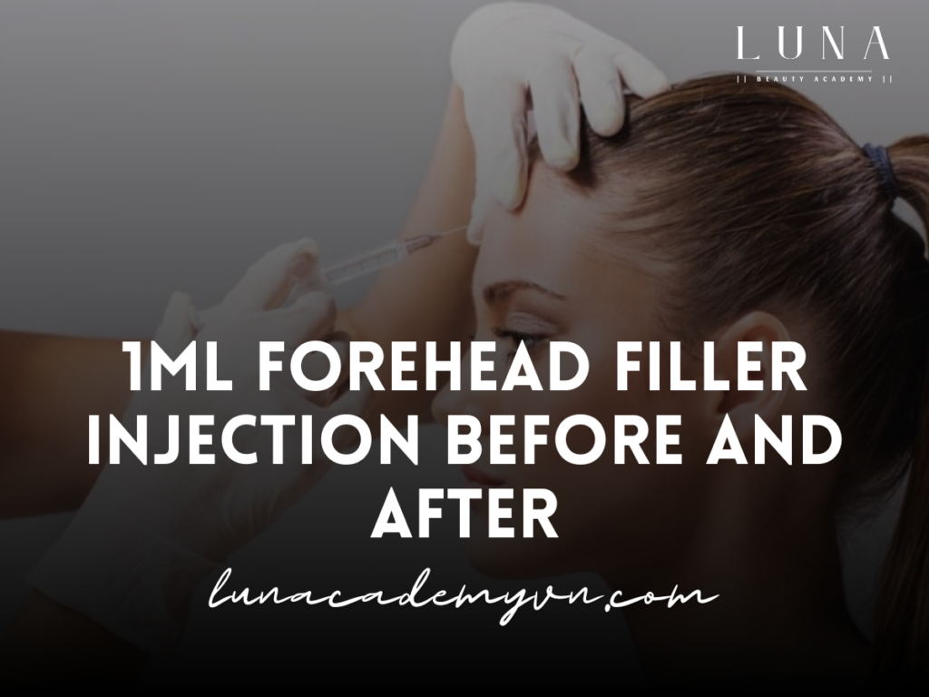 1ml forehead filler injection before and after