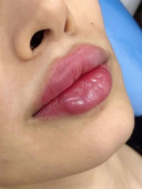 1ml Hyaluronic Acid Lip Fillers Before and After