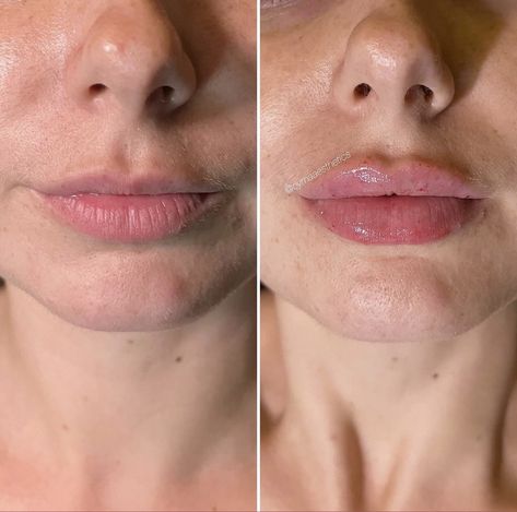 1ml Hyaluronic Acid Lip Fillers Before and After