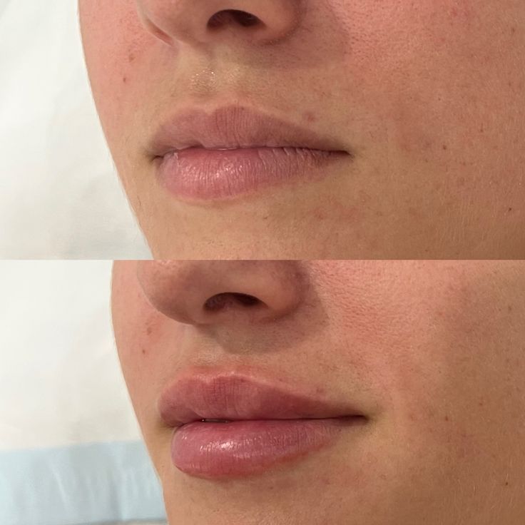 1ml Hyaluronic Acid Lip Fillers Before and After