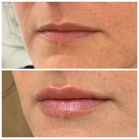 1ml Hyaluronic Acid Lip Fillers Before and After