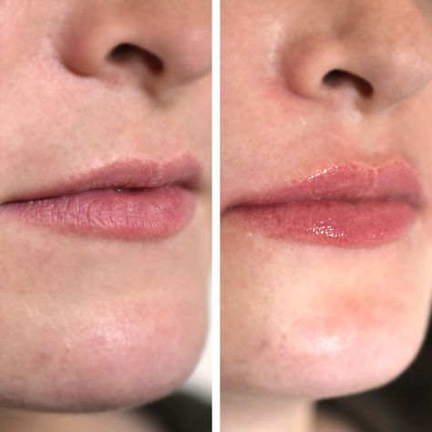 1ml Hyaluronic Acid Lip Fillers Before and After