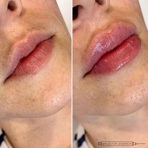 1ml Hyaluronic Acid Lip Fillers Before and After