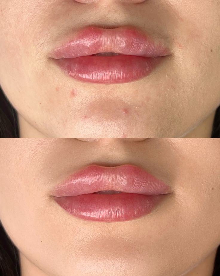 1ml Hyaluronic Acid Lip Fillers Before and After