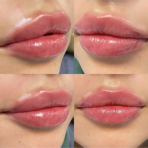 1ml Hyaluronic Acid Lip Fillers Before and After