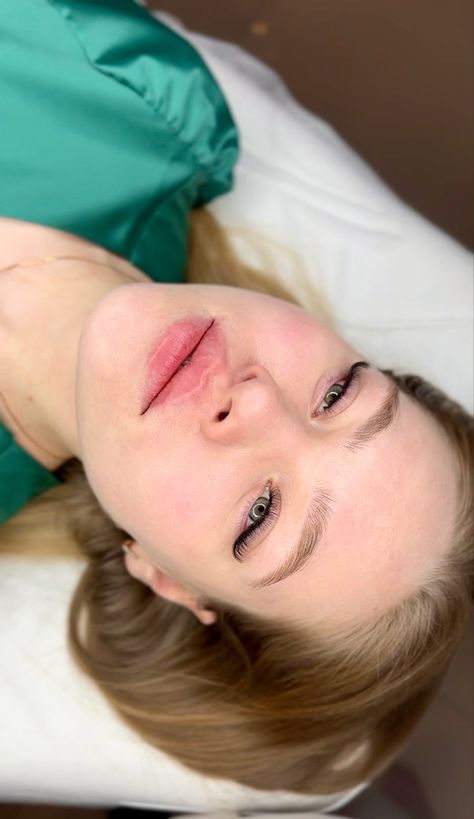 1ml Lip Fillers Near Me Quezon