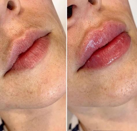 1ml Lip Fillers Near Me Quezon