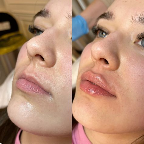 1ml Lip Fillers Near Me Quezon