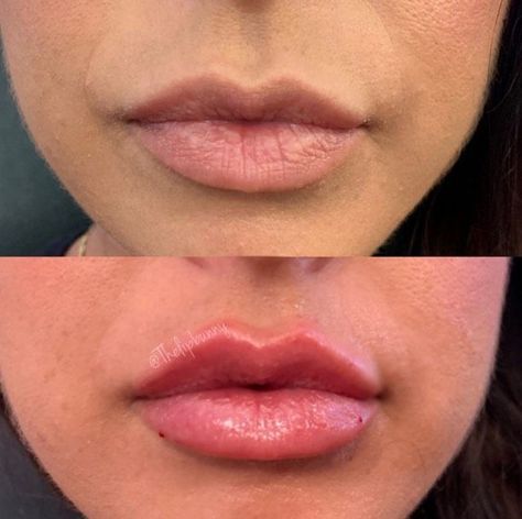 1ml Lip Injections: A Comprehensive Guide to Perfect Pout