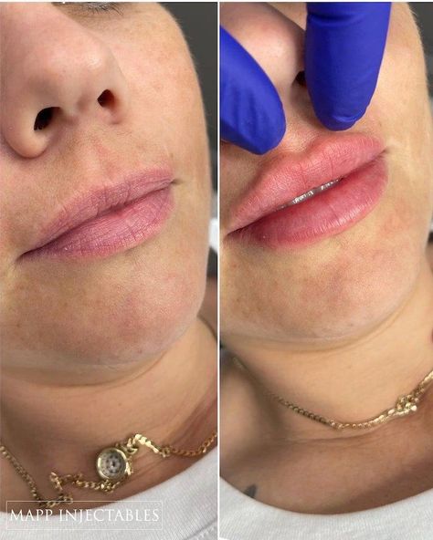 1ml Lip Injections: A Comprehensive Guide to Perfect Pout