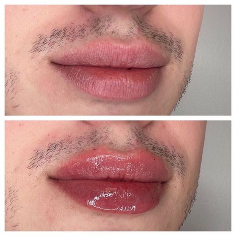 1ml Lip Injections: A Comprehensive Guide to Perfect Pout