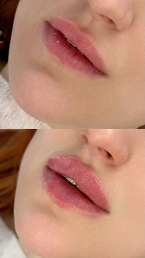 1ml Lip Injections: A Comprehensive Guide to Perfect Pout