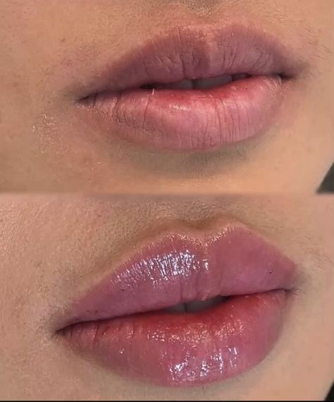 1ml Lip Injections: A Comprehensive Guide to Perfect Pout