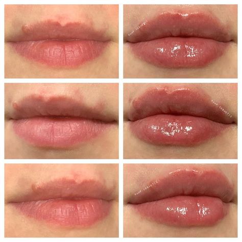 1ml Lip Injections: A Comprehensive Guide to Perfect Pout