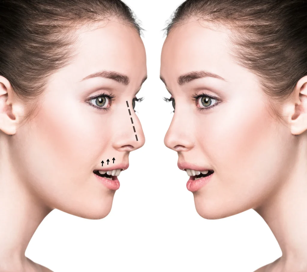 Rhinoplasty