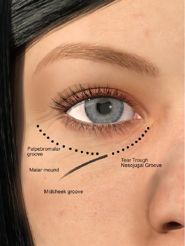 anatomy-of-the-tear-trough-area