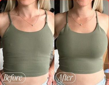 Aptos Threading Breasts: A New Lift Technique for Natural