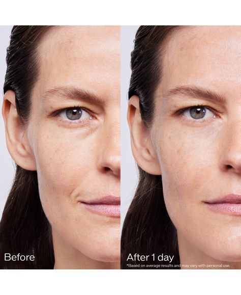 Before and After Hyaluronic Acid Fillers: Transformations