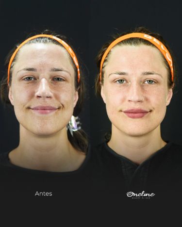 Before and After Hyaluronic Acid Fillers: Transformations