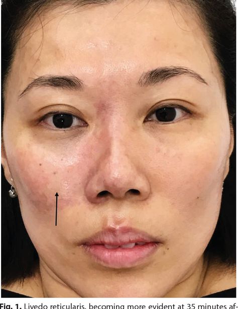 Before and After Hyaluronic Acid Fillers: Transformations