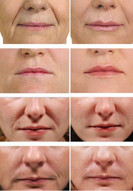 Before and After Hyaluronic Acid Fillers: Transformations