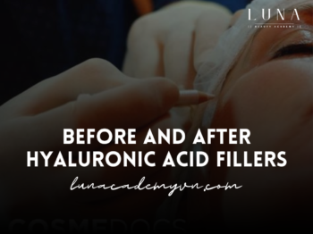 Before and After Hyaluronic Acid Fillers: Transformations