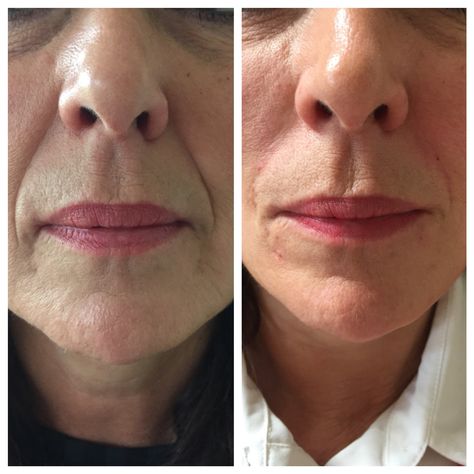 Before and After Hyaluronic Acid Fillers: Transformations