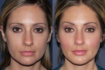 Before and After Hyaluronic Acid Fillers: Transformations