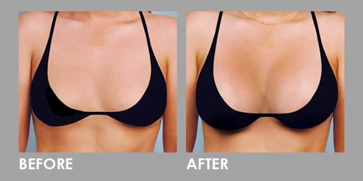 benefits-of-using-breast-fillers