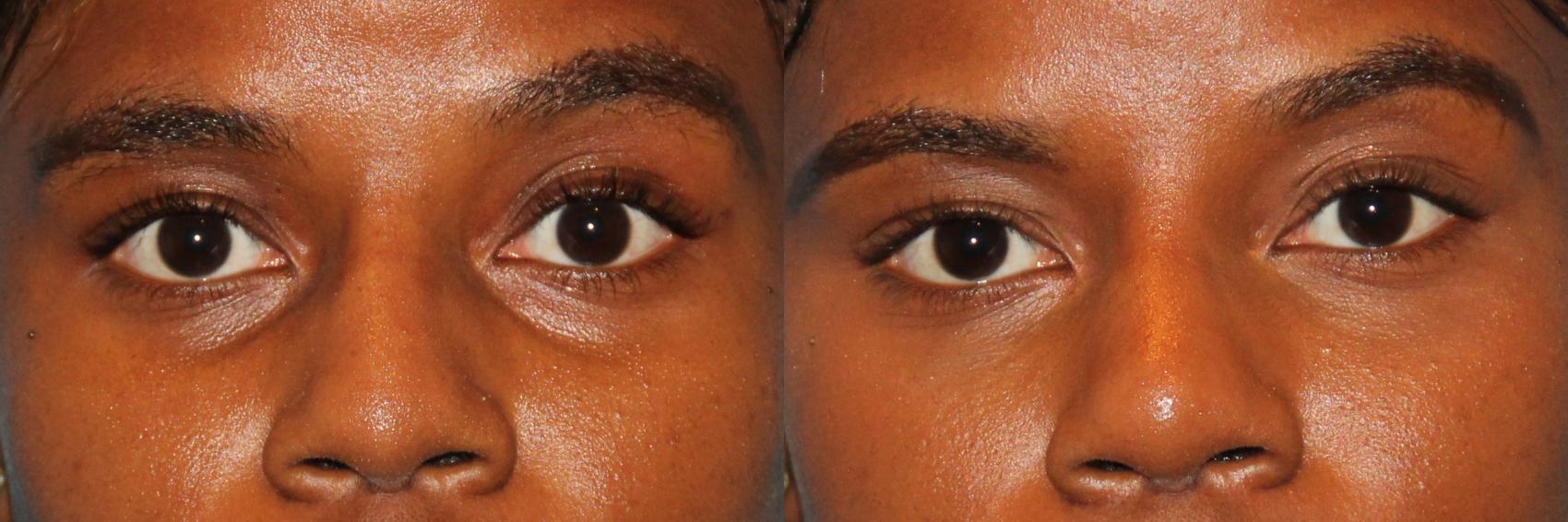 Botox Before and After Eyes A Comprehensive Guide