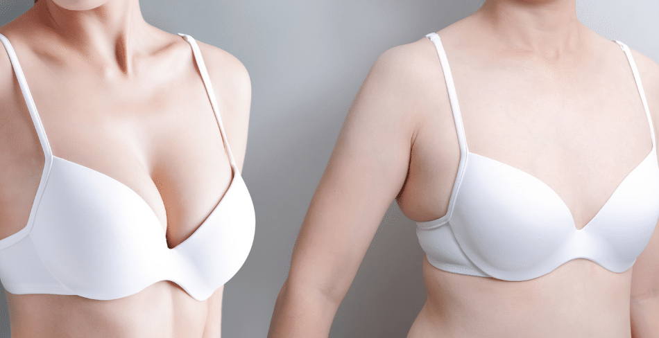 The Journey of Breast Expansion