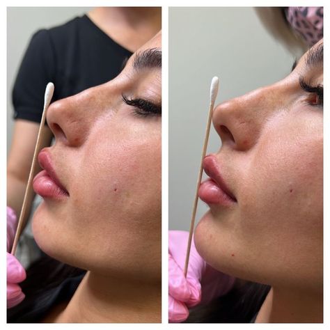 Breast Filler Injections Cost: A Comprehensive Guide