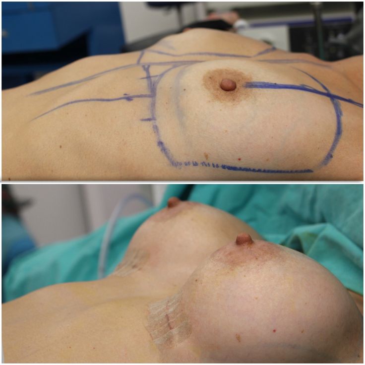 Breast Surgery Available in the Philippines