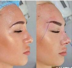 Brow Bone Filler Before and After