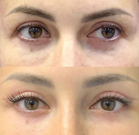 Brow Bone Filler Before and After