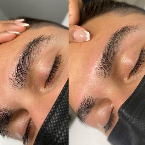 Brow Ridge Filler: Enhancing Masculine Features 