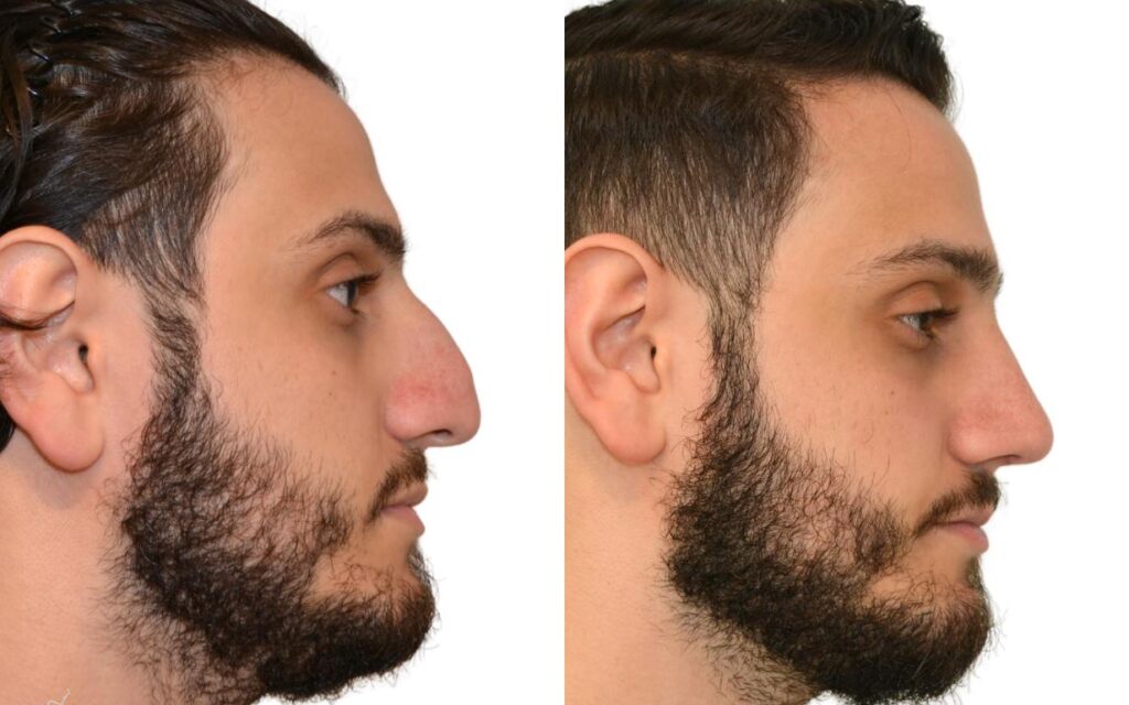  Bulbous Nose Non-Surgical Nose 