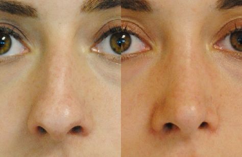 Bulbous Tip Rhinoplasty Before and After