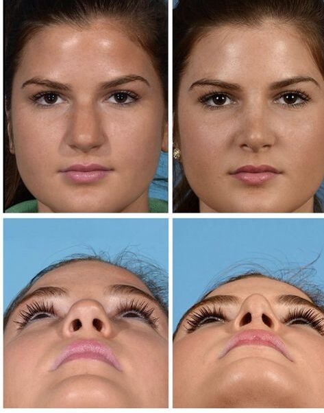 Bulbous Tip Rhinoplasty Before and After