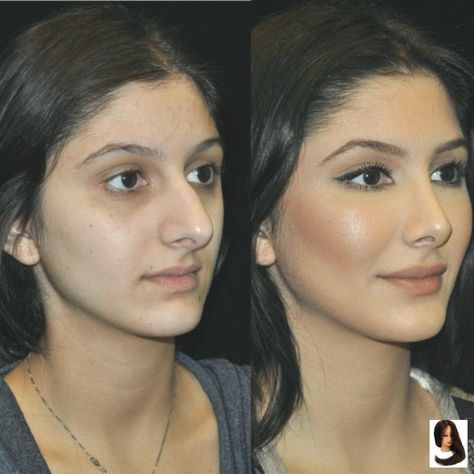 Bulbous Tip Rhinoplasty Before and After