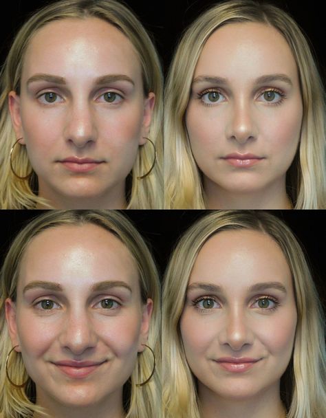 Bulbous Tip Rhinoplasty Before and After