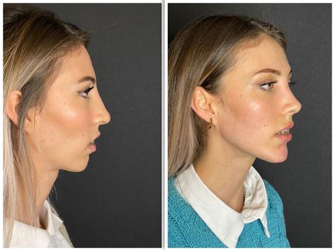 Bulbous Tip Rhinoplasty Before and After