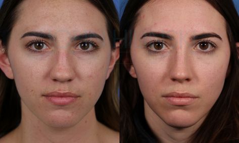 Bulbous Tip Rhinoplasty Before and After