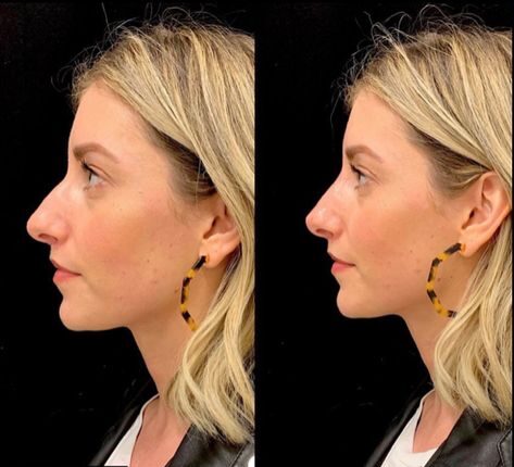 Bulbous Tip Rhinoplasty Before and After