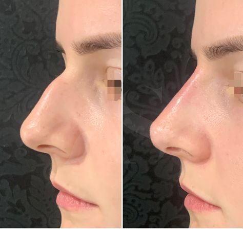 Can You Get Nose Filler While Breastfeeding?