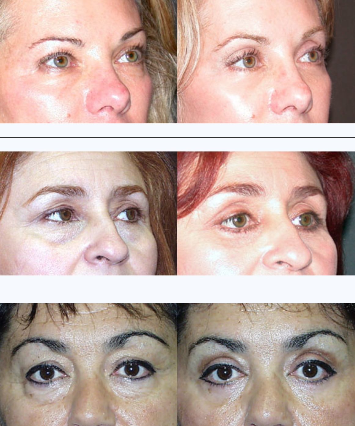 candidates-for-eye-lift-fillers