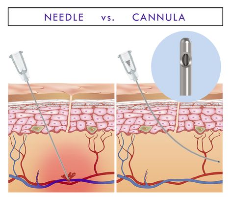 Cannula versus Needle Manila: Aesthetic Treatments