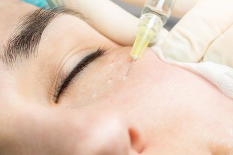 Cannula versus Needle Manila: Aesthetic Treatments